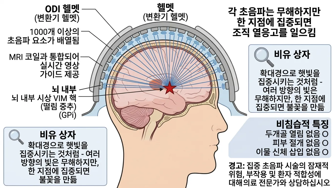 집속 초음파 수술(FUS) — 비침습적 뇌 수술 원리